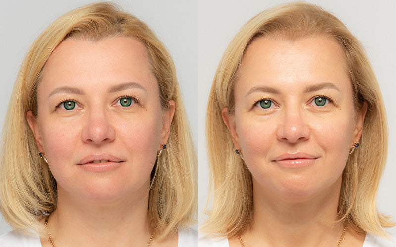 Before and after: firmness and contour improvement