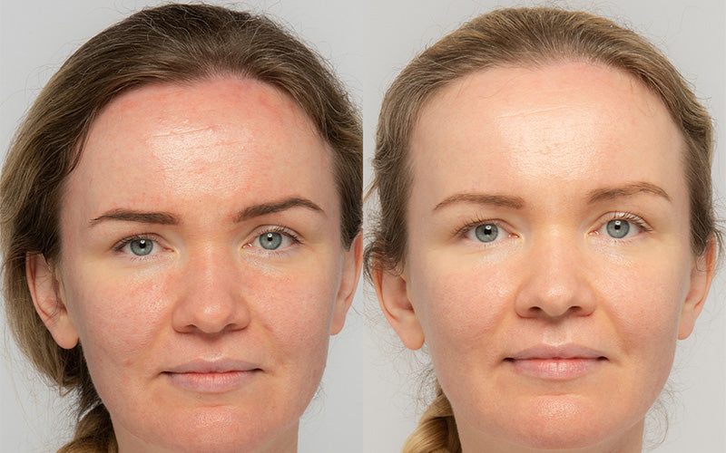 Before and after: redness and sensitivity reduction